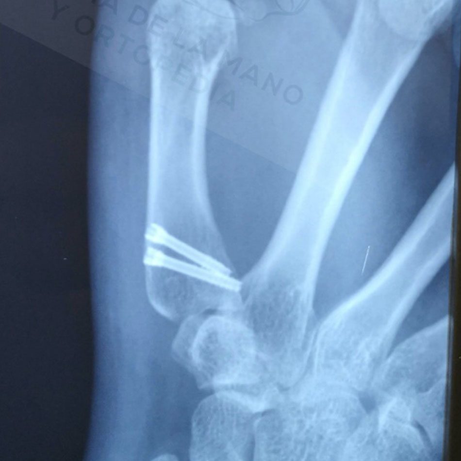 Fractura de Bennett: osteosíntesis con tornillos canulados, vista frontal