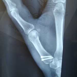 Fractura de Bennett: osteosíntesis con tornillos canulados, vista lateral