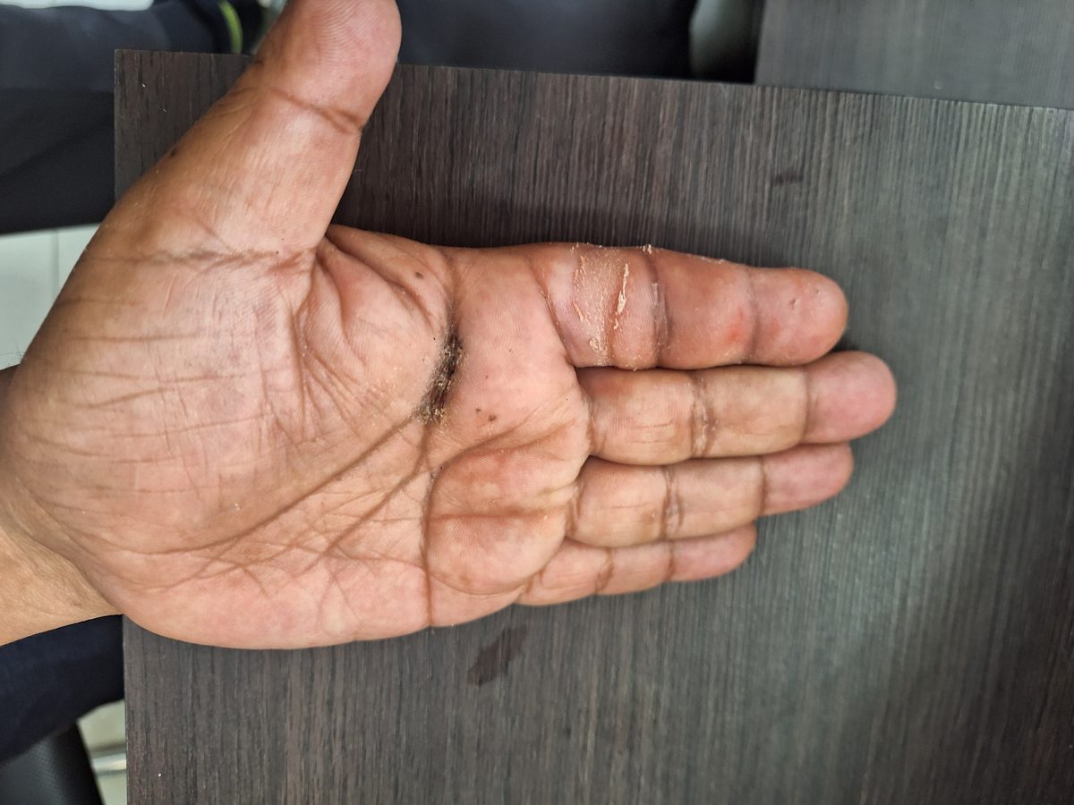 Deformidad de Boutonnière: mano vista palmar tras la cirugía