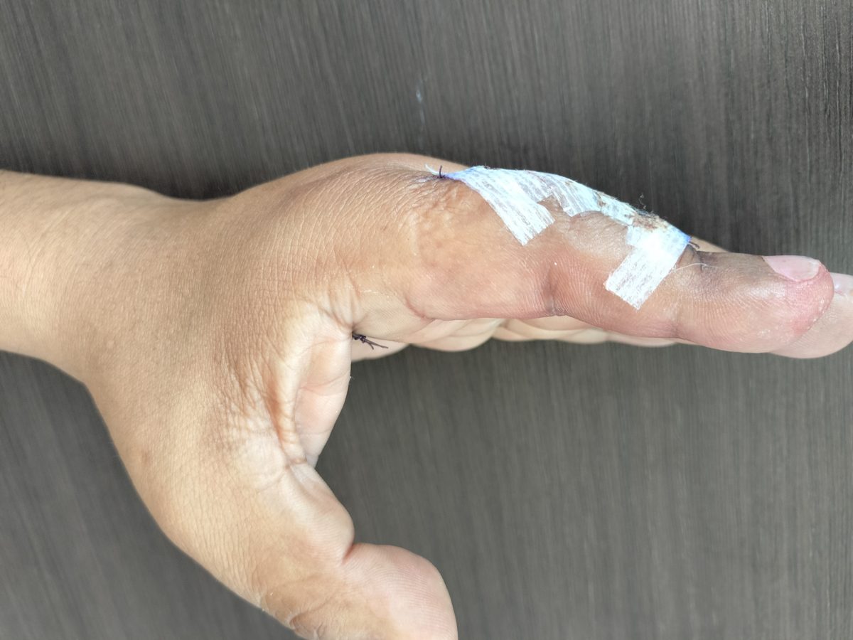 Deformidad de Boutonnière: dedo con vendaje postoperatorio