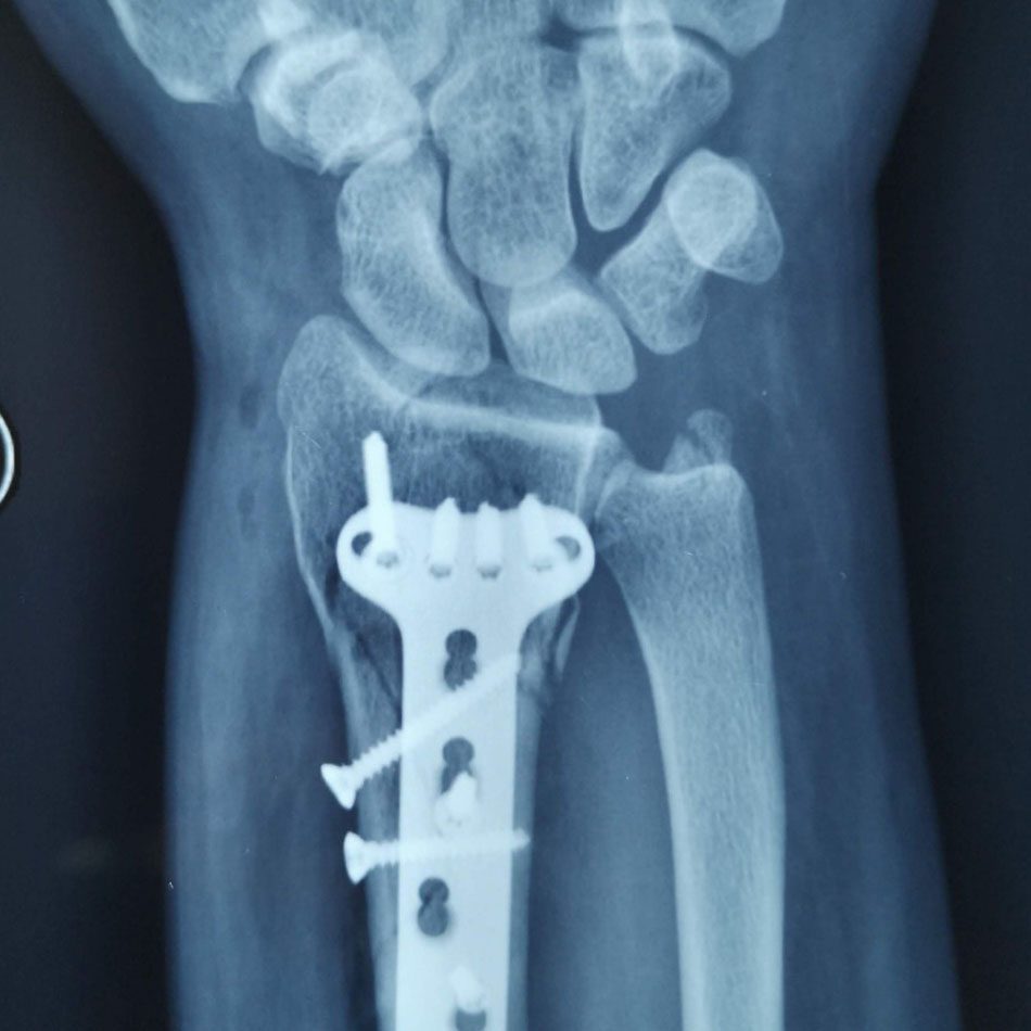 Fractura de muñeca: radiografía con placa anatómica, vista frontal