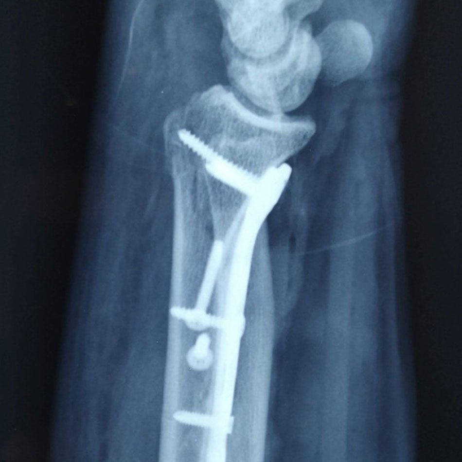 Fractura de muñeca: radiografía con placa anatómica, vista lateral