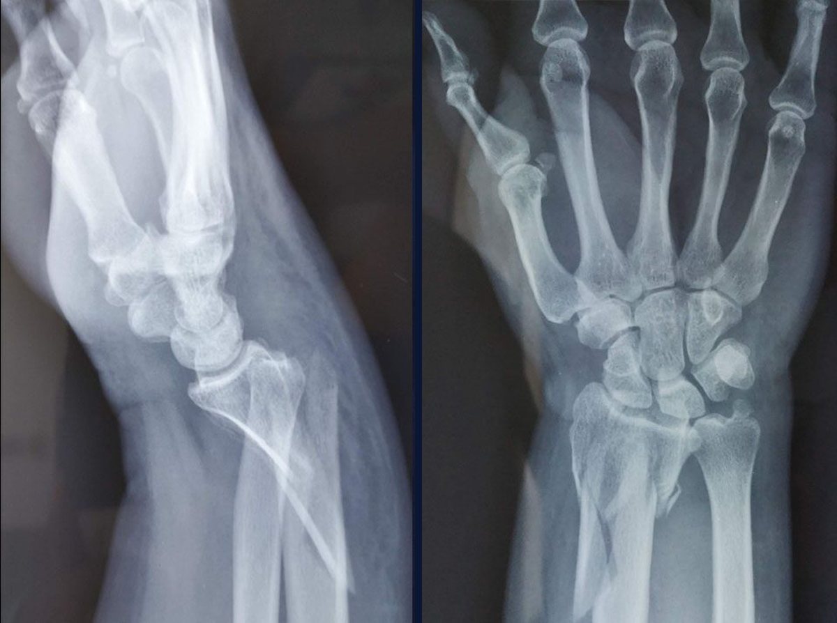 Fractura de muñeca: radiografías lateral y frontal antes de la cirugía