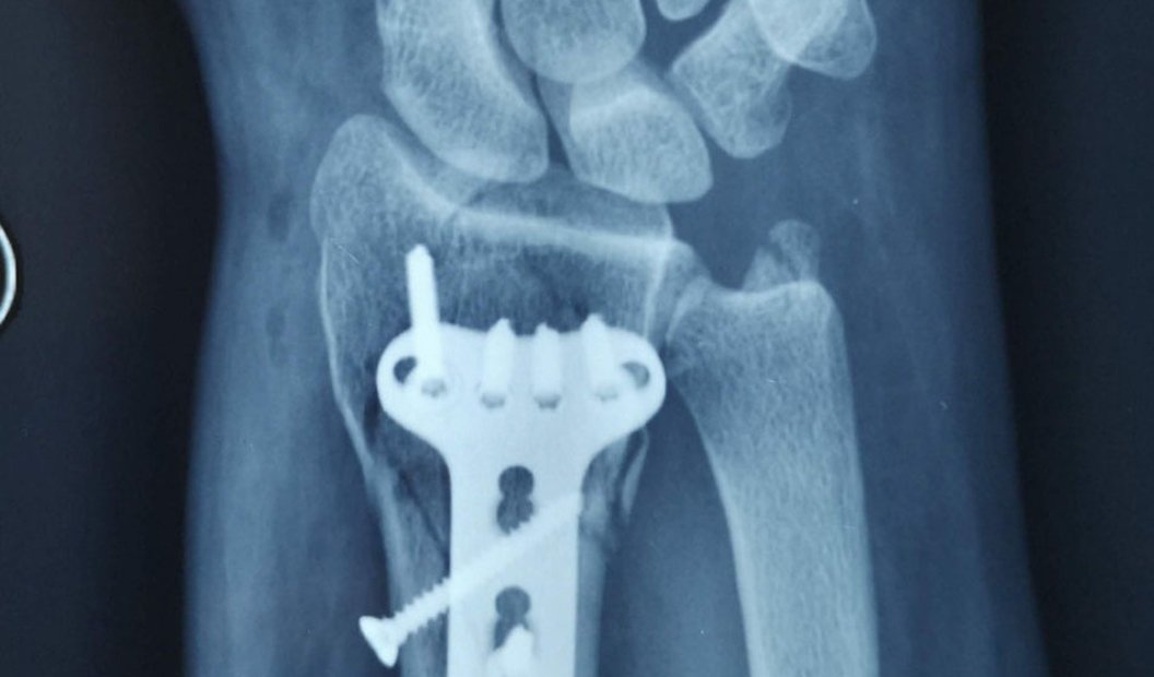 Fractura de muñeca